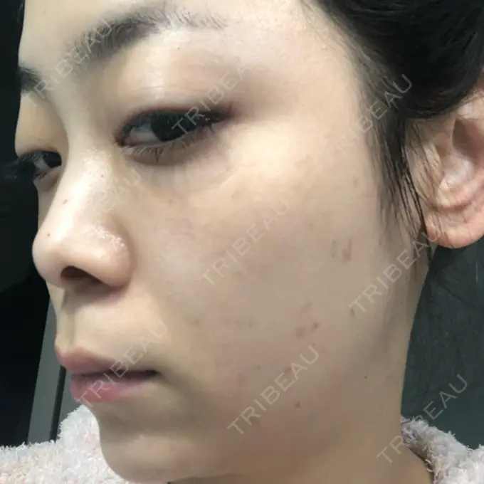 ほくろ・いぼ切除（肌） / シミ取りレーザー / ピコレーザートーニング（美白・肝斑） セオリークリニック DAY 6 メイン用