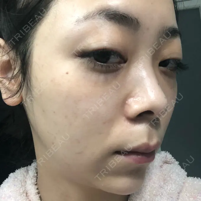 ほくろ・いぼ切除（肌） / シミ取りレーザー / ピコレーザートーニング（美白・肝斑） セオリークリニック DAY 6 メイン用