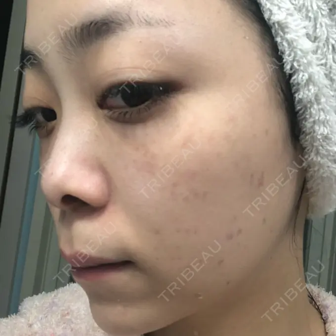 ほくろ・いぼ切除（肌） / シミ取りレーザー / ピコレーザートーニング（美白・肝斑） セオリークリニック DAY 7 メイン用