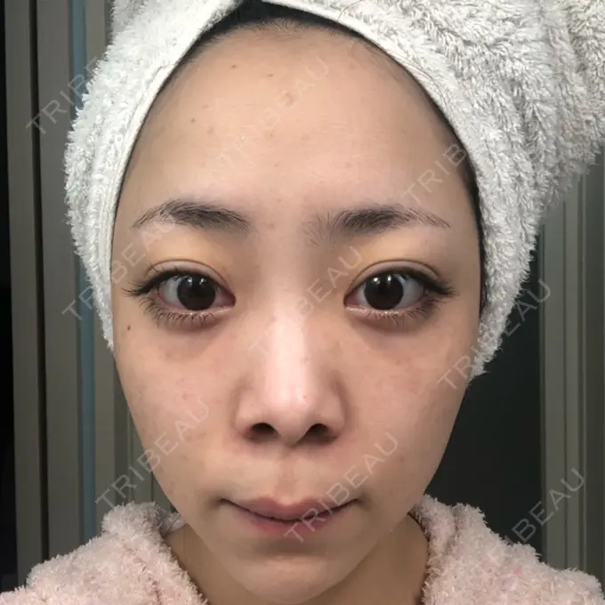 ほくろ・いぼ切除（肌） / シミ取りレーザー / ピコレーザートーニング（美白・肝斑） セオリークリニック AFTER メイン用