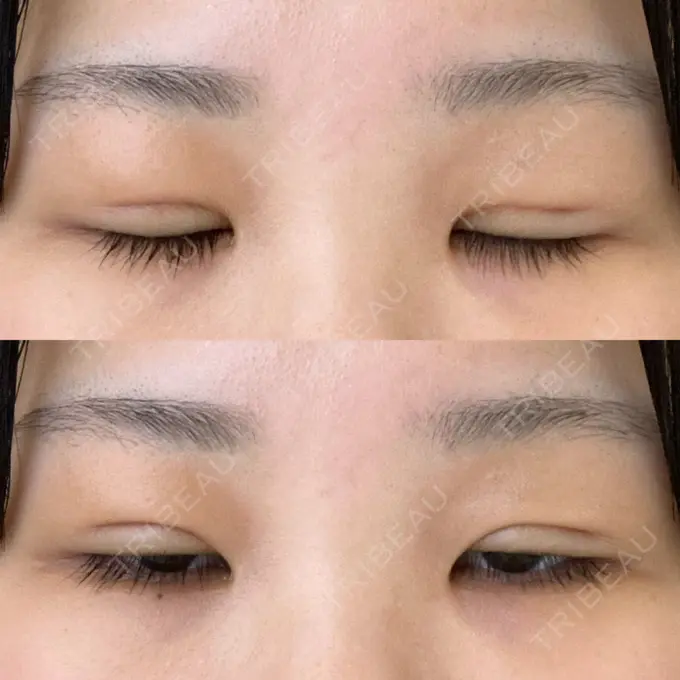 二重埋没 / 上まぶたの脂肪取り 品川スキンクリニック広島院 DAY 9 メイン用