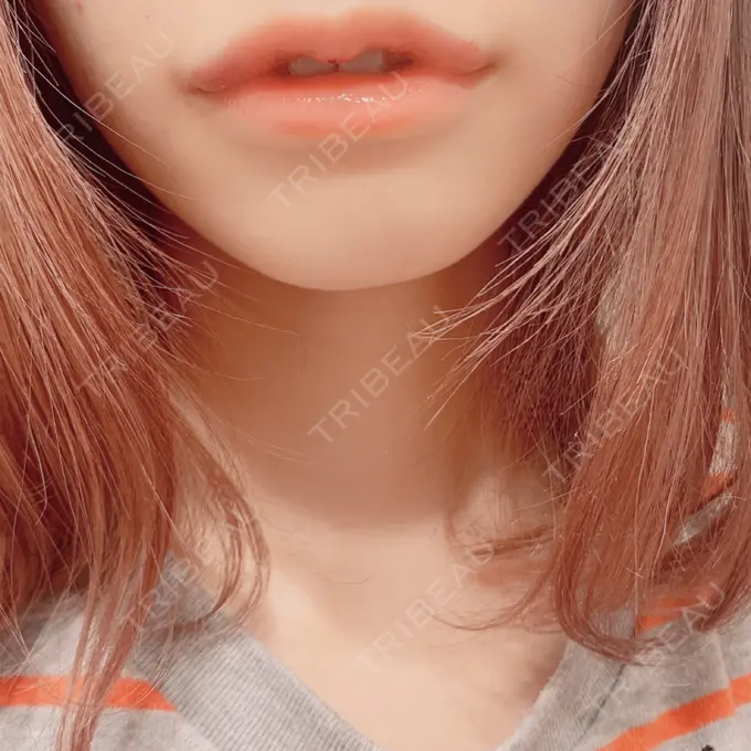 ヒアルロン酸注入（唇） / ボトックス（口角） ルラ美容クリニック 新宿院 DAY 5 メイン用