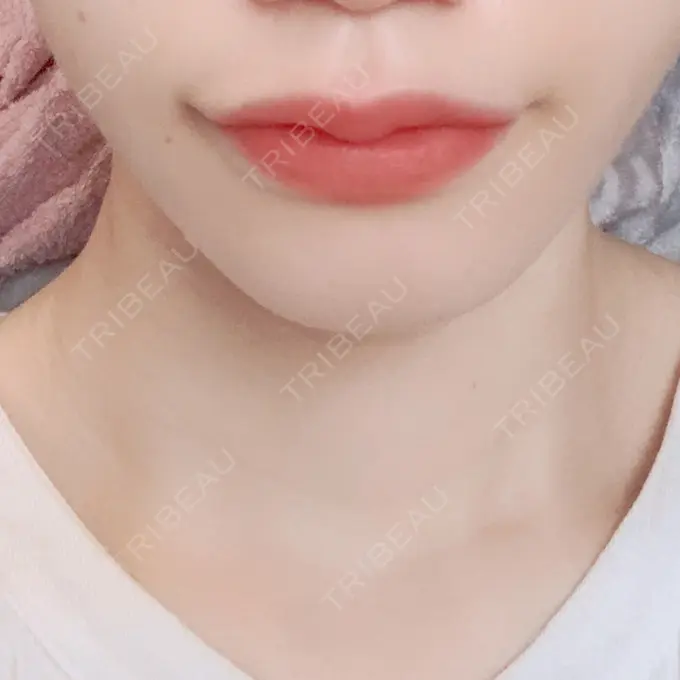 ヒアルロン酸注入（唇） / ボトックス（口角） ルラ美容クリニック 新宿院 DAY 6 メイン用