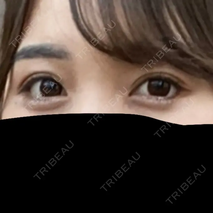 眼瞼下垂（切開） / 目尻切開 / タレ目形成・グラマラスライン（切開） プロミス整形外科 AFTER メイン用