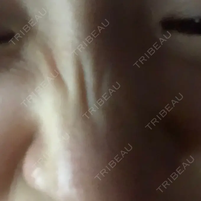 ボトックス（あご） 湘南美容クリニック 銀座院 DAY 4 メイン用