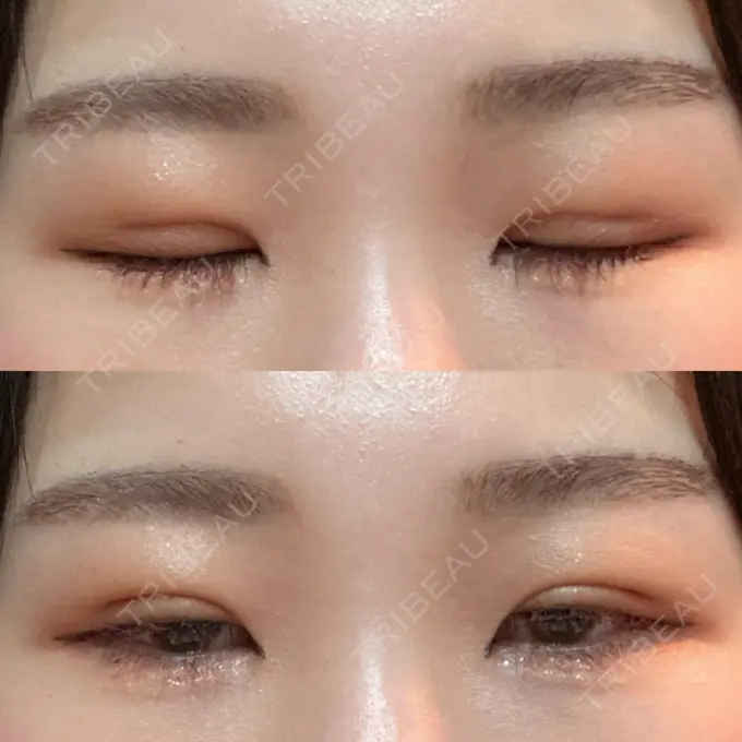 二重埋没 / 上まぶたの脂肪取り 品川スキンクリニック広島院 DAY 10 メイン用