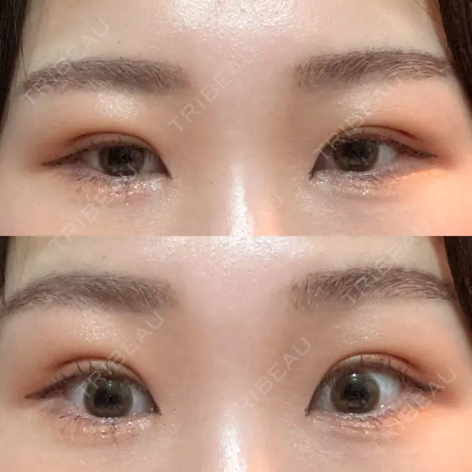 二重埋没 / 上まぶたの脂肪取り 品川スキンクリニック広島院 DAY 10 メイン用