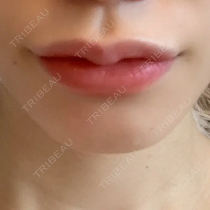 ヒアルロン酸注入（唇） / ボトックス（口角） ルラ美容クリニック 新宿院 DAY 7 メイン用