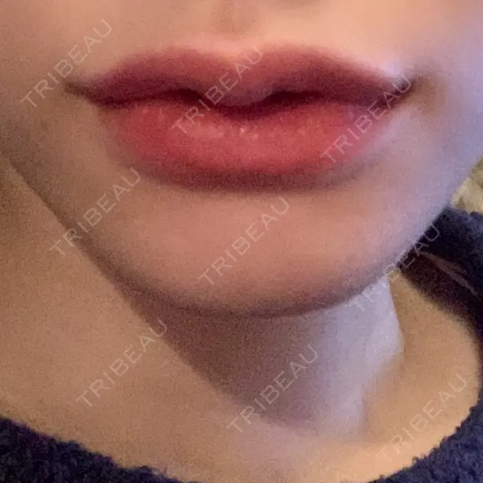 ヒアルロン酸注入（唇） / ボトックス（口角） ルラ美容クリニック 新宿院 AFTER メイン用