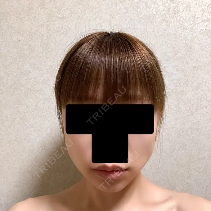 バッカルファット除去 / ボトックス（エラ・小顔） 湘南美容クリニック 金山院 DAY 6 メイン用