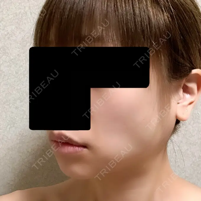 バッカルファット除去 / ボトックス（エラ・小顔） 湘南美容クリニック 金山院 DAY 6 メイン用