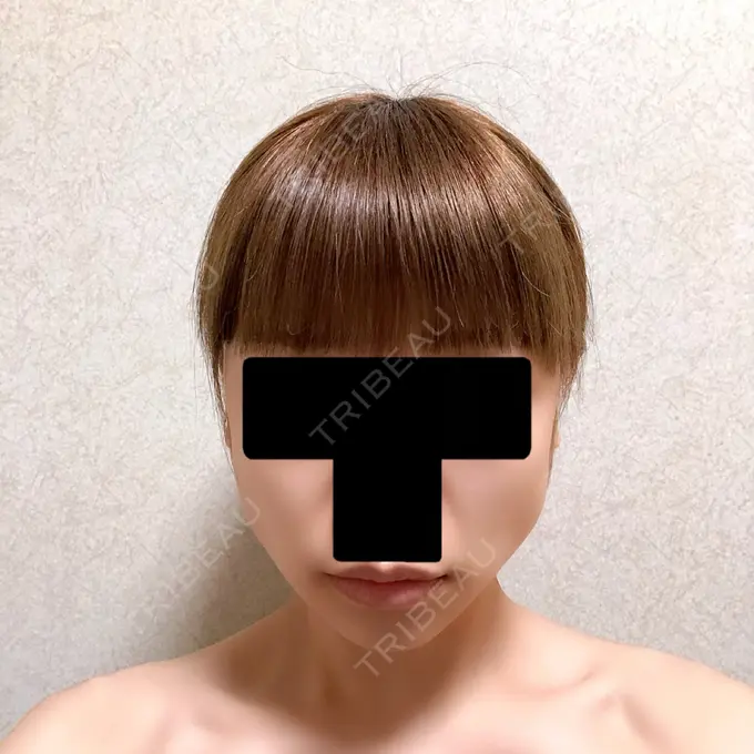 バッカルファット除去 / ボトックス（エラ・小顔） 湘南美容クリニック 金山院 AFTER メイン用