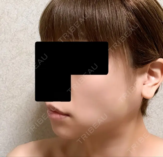 バッカルファット除去 / ボトックス（エラ・小顔） 湘南美容クリニック 金山院 DAY 7 メイン用