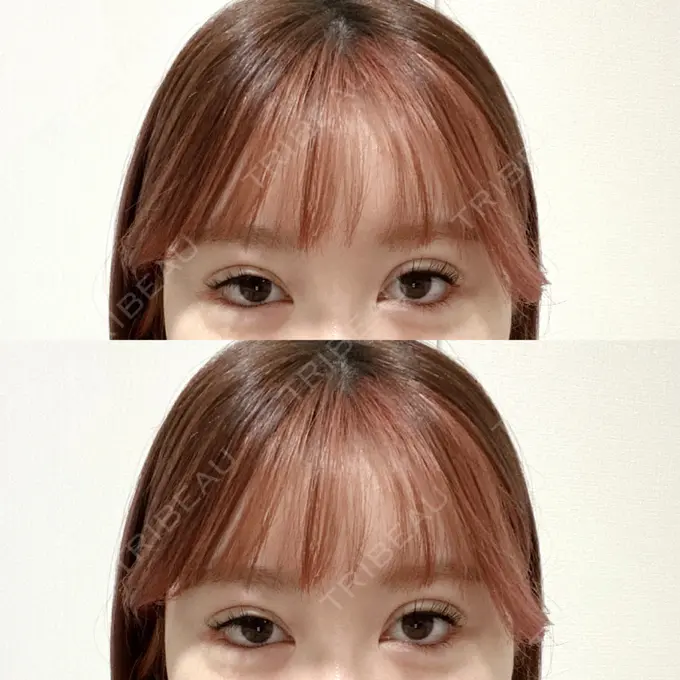 二重埋没 CLASSY 仙台美容外科・美容皮膚科 AFTER メイン用