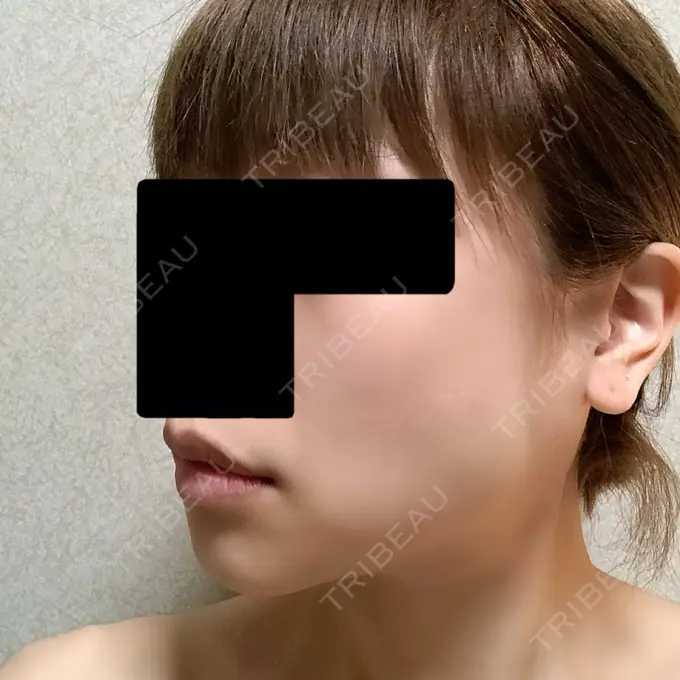 バッカルファット除去 / ボトックス（エラ・小顔） 湘南美容クリニック 金山院 DAY 5 メイン用