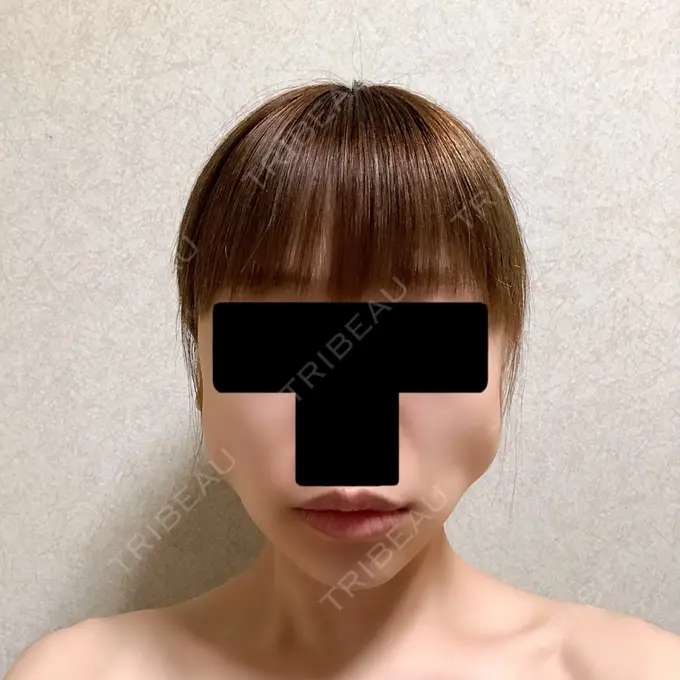 バッカルファット除去 / ボトックス（エラ・小顔） 湘南美容クリニック 金山院 DAY 6 メイン用