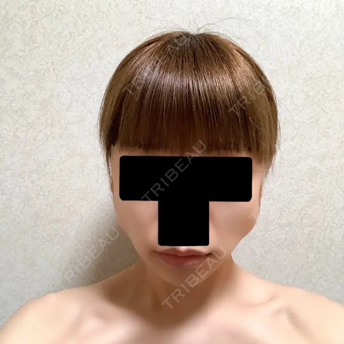 バッカルファット除去 / ボトックス（エラ・小顔） 湘南美容クリニック 金山院 DAY 7 メイン用