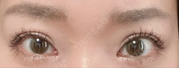 二重切開 / 目頭切開 心斎橋コムロ美容外科クリニック DAY 135 メイン用