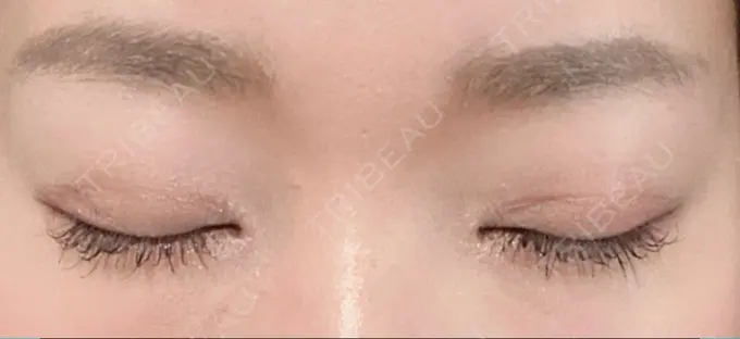 二重切開 / 目頭切開 心斎橋コムロ美容外科クリニック DAY 135 メイン用