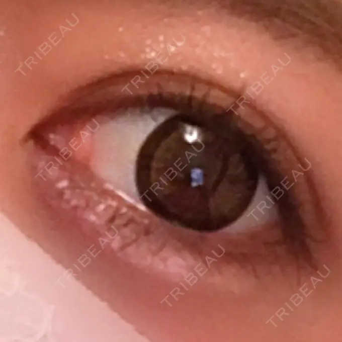 ヒアルロン酸注入（涙袋） プライベートスキンクリニック 梅田本院 DAY 2 メイン用