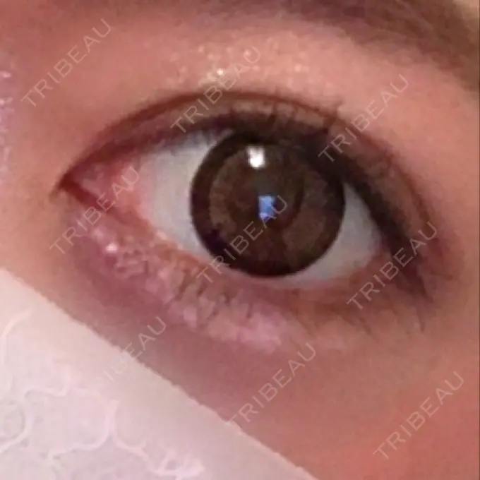 ヒアルロン酸注入（涙袋） プライベートスキンクリニック 梅田本院 DAY 2 メイン用