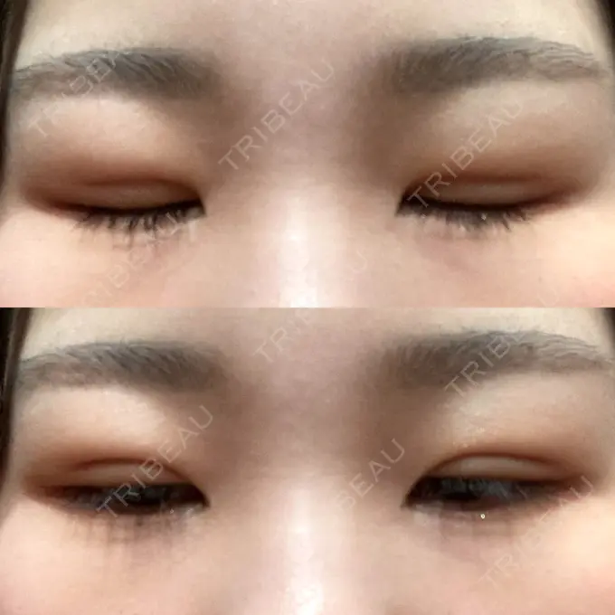 二重埋没 / 上まぶたの脂肪取り 品川スキンクリニック広島院 DAY 11 メイン用