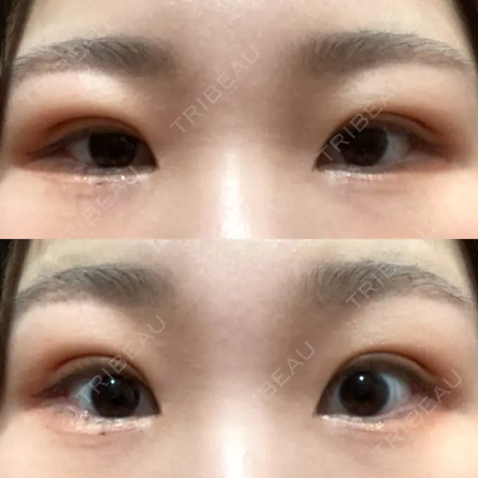 二重埋没 / 上まぶたの脂肪取り 品川スキンクリニック広島院 DAY 11 メイン用