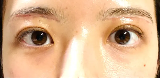 眉下切開 Taide Suenaga Clinic（タイデスエナガクリニック） DAY 16 メイン用