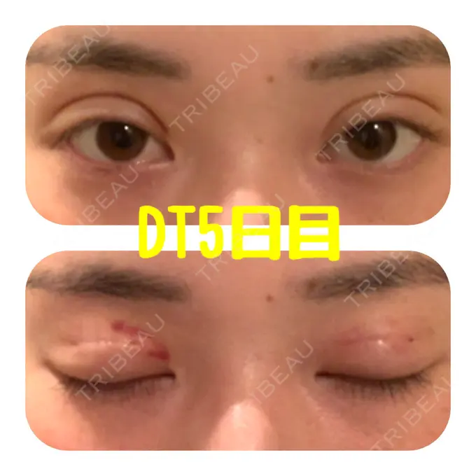 二重埋没 ハナビューティークリニック DAY 5 メイン用