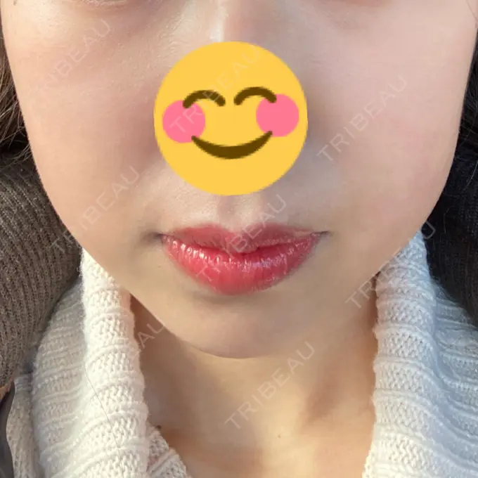 脂肪溶解注射（顔） 大西皮フ科形成外科医院 滋賀大津石山院 DAY 22 メイン用