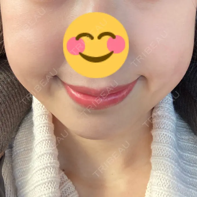 脂肪溶解注射（顔） 大西皮フ科形成外科医院 滋賀大津石山院 DAY 22 メイン用