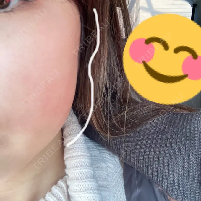 脂肪溶解注射（顔） 大西皮フ科形成外科医院 滋賀大津石山院 DAY 22 メイン用