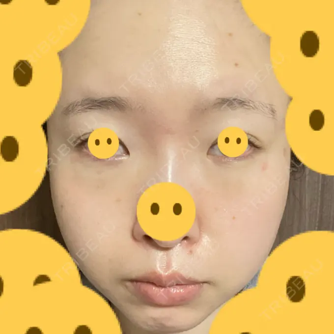 クマ治療 / 上まぶたたるみ取り / 下まぶたたるみ取り / シミ取りレーザー 赤坂プレミアクリニック DAY 6 メイン用