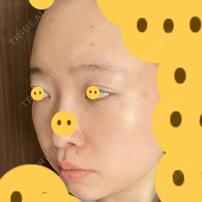 クマ治療 / 上まぶたたるみ取り / 下まぶたたるみ取り / シミ取りレーザー 赤坂プレミアクリニック DAY 7 メイン用