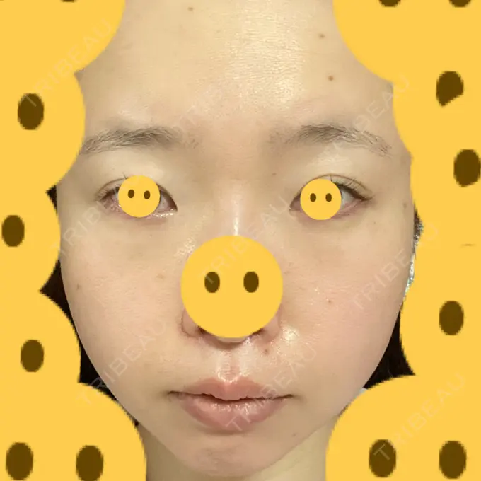 クマ治療 / 上まぶたたるみ取り / 下まぶたたるみ取り / シミ取りレーザー 赤坂プレミアクリニック AFTER メイン用