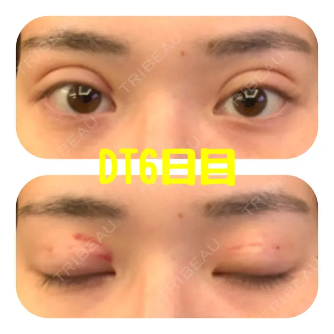 二重埋没 ハナビューティークリニック DAY 6 メイン用