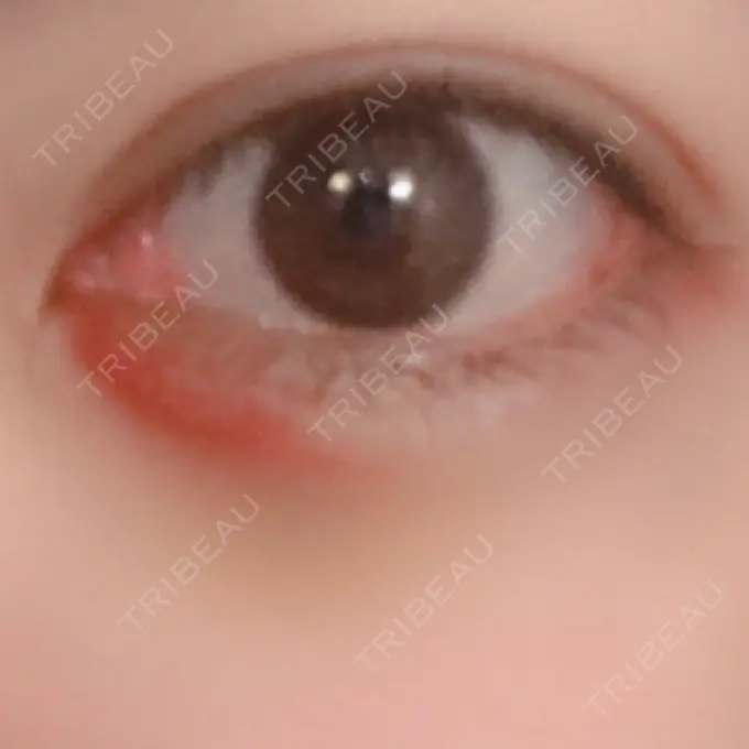 ヒアルロン酸注入（涙袋） プライベートスキンクリニック 梅田本院 DAY 5 メイン用