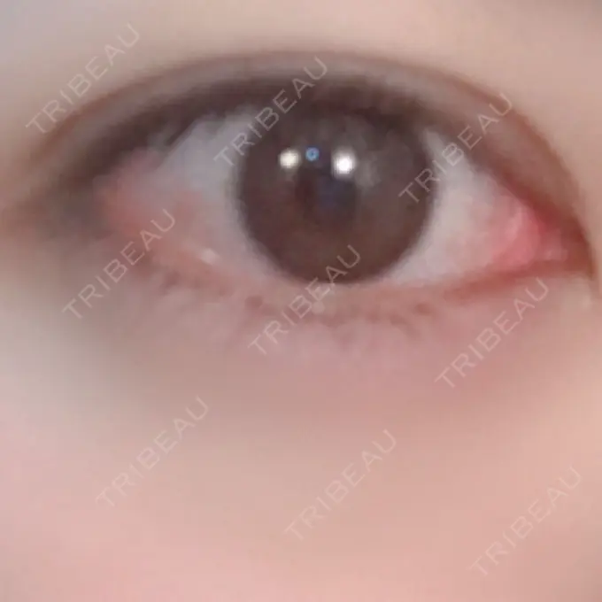 ヒアルロン酸注入（涙袋） プライベートスキンクリニック 梅田本院 DAY 5 メイン用