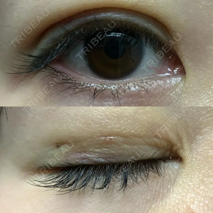 二重埋没 札幌ル・トロワ ビューティクリニックVogue DAY 3 メイン用