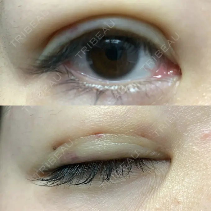 二重埋没 札幌ル・トロワ ビューティクリニックVogue DAY 3 メイン用