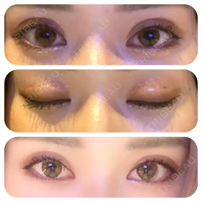 二重埋没 ハナビューティークリニック DAY 7 メイン用