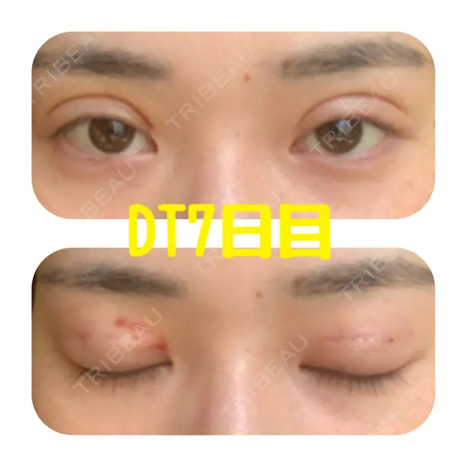 二重埋没 ハナビューティークリニック DAY 7 メイン用