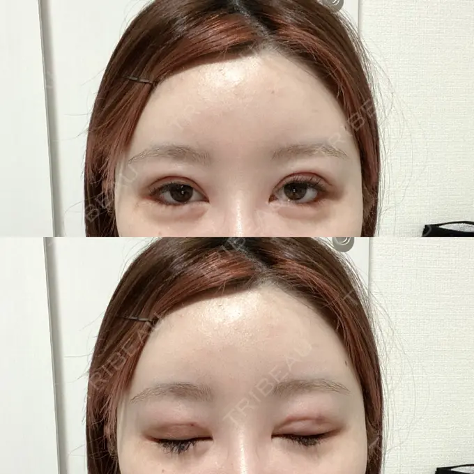 二重埋没 / その他（目元） CLASSY 仙台美容外科・美容皮膚科 DAY 2 メイン用