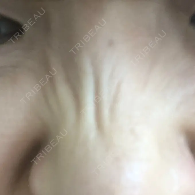 ボトックス（あご） 湘南美容クリニック 銀座院 DAY 5 メイン用