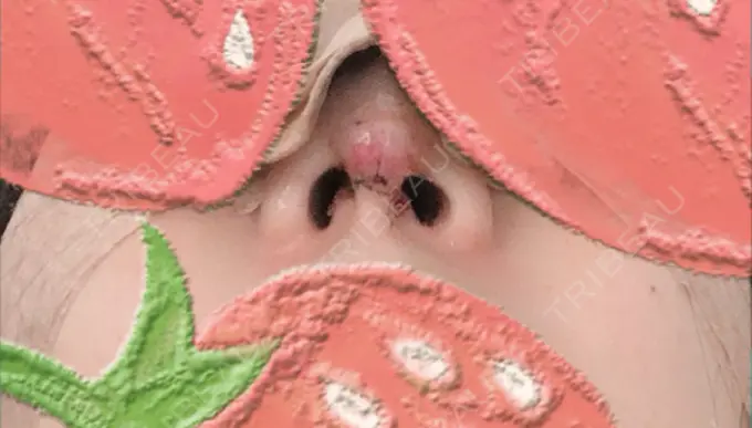 鼻尖形成（切開） / 軟骨移植 / ワシ鼻修正・ハンプ切除 麹町皮ふ科・形成外科クリニック DAY 2 メイン用