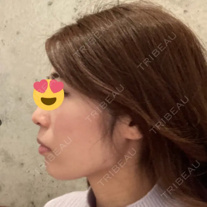 脂肪吸引（顔） ジョウクリニック 大阪院 DAY 64 メイン用