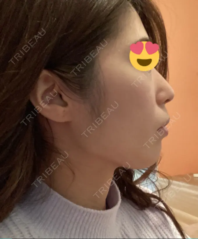 脂肪吸引（顔） ジョウクリニック 大阪院 DAY 64 メイン用