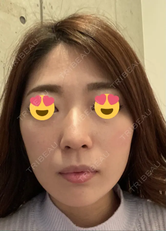 脂肪吸引（顔） ジョウクリニック 大阪院 DAY 64 メイン用