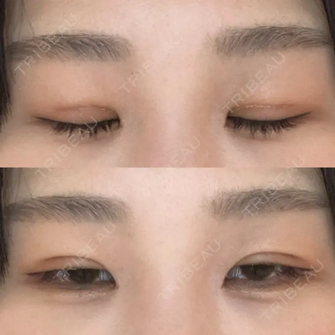 二重埋没 / 上まぶたの脂肪取り 品川スキンクリニック広島院 DAY 14 メイン用