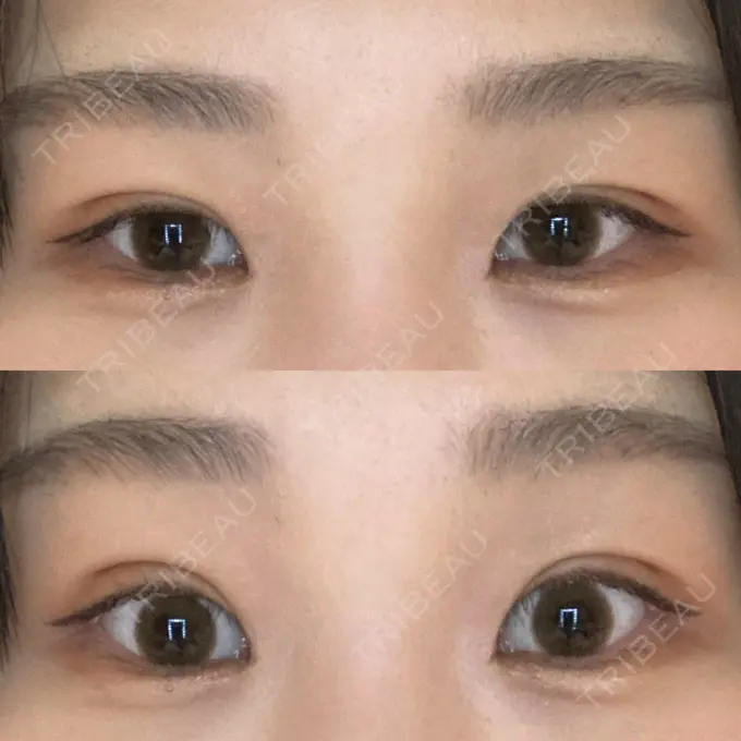 二重埋没 / 上まぶたの脂肪取り 品川スキンクリニック広島院 DAY 14 メイン用